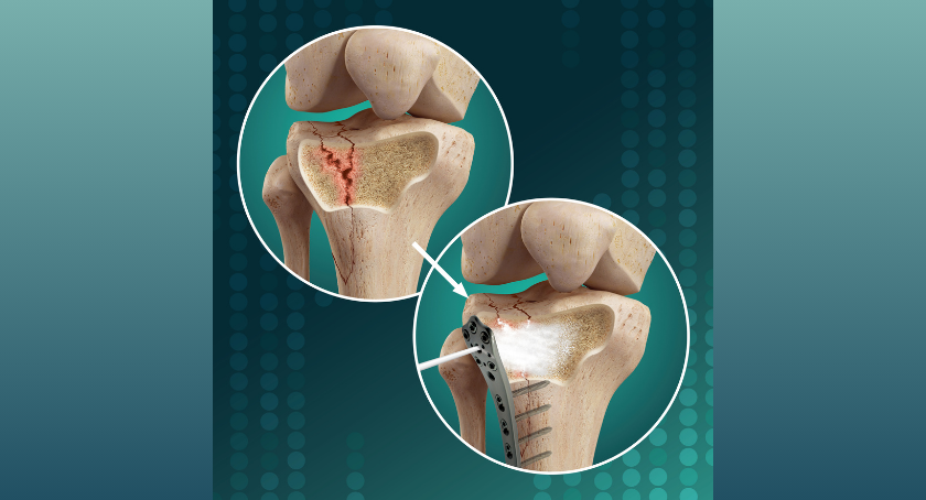MHRA Approves Study of Biomimetic Innovations’ Injectable Synthetic Bone Void Filler